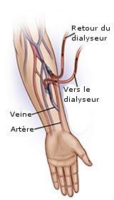 vaisseau de dialyse