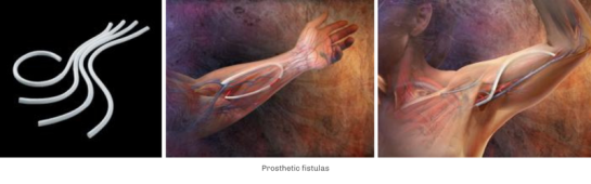abords-pour-hemodialyse-fistules-prothetiques