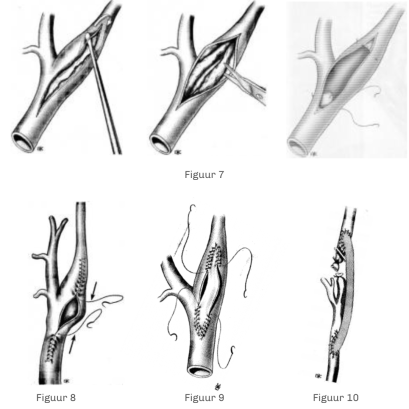 Heelkunde van de carotiden - behandeling