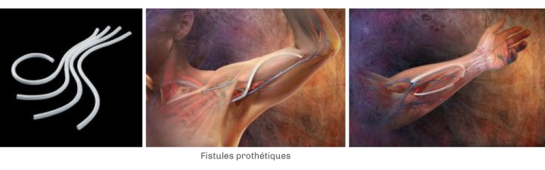 hemodialyse-fistules-prothétiques