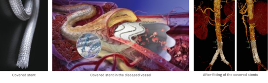 occlusive arterial diseases stent
