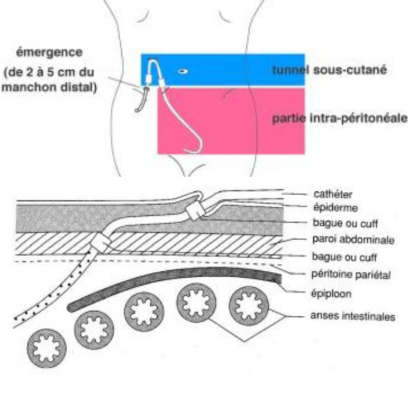plaatsing van de catheter